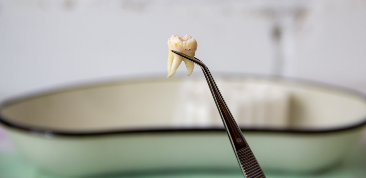 Ein ausgefallener Zahn vor einer Schale, festgehalten durch eine Zange.