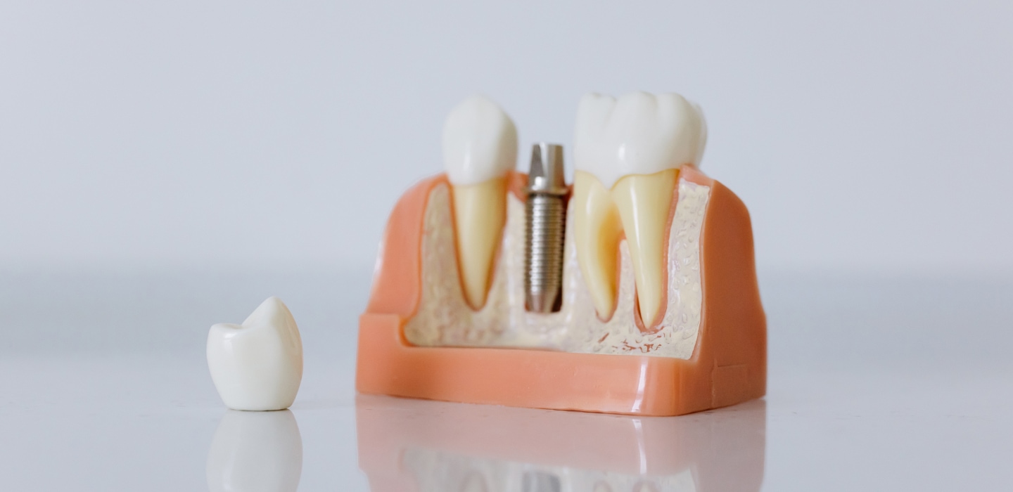 Zahnimplantat - Welche Vorteile bietet Ihnen ein Zahnimplantat
